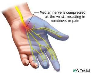 carpal tunnel in pregnancy