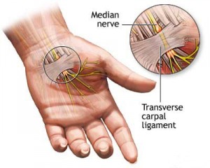 carpal tunnel in Pregnancy
